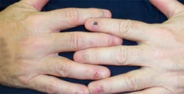 tırnaklarda oluşan Liken Planus