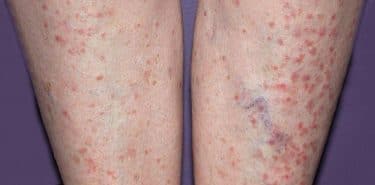 Liken Planus belirtileri