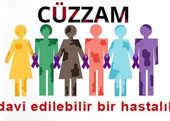 Cüzzam (Lepra) nedir? Nasıl bulaşır? Belirtileri ve tedavisi
