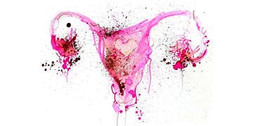 Endometriozis (çikolata kisti) nedir? Belirtileri, nedenleri ve tedavisi