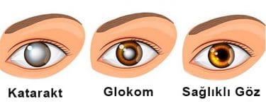 Normal Göz / Glokom / Katarakt