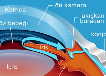 Göz tansiyonu (Glokom) nedir? Nedenleri, belirtileri ve tedavisi