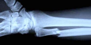 Kemik kırığı teşhisi ve röntgen filmi