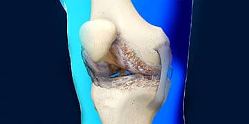 Kireçlenmede ameliyatsız tedavi mümkün mü? Uzmanlar ne öneriyor?