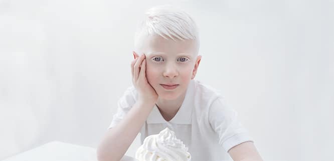 albino albinizm nedir neden olur albinonun belirtileri ve tedavisi