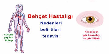 Behçet Hastalığı nedir? Neden olur? Belirtileri ve tedavisi