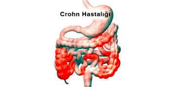 Crohn Hastalığı nedir? Neden olur? Belirtileri ve tedavisi