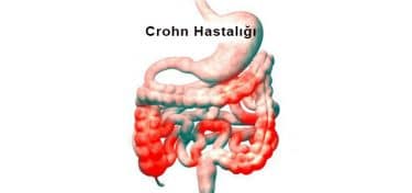Crohn Hastalığı 