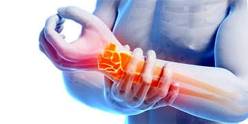 Karpal Tünel Sendromu nedir? Nedenleri, belirtileri ve tedavisi