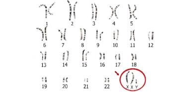 Klinefelter sendromu, X kromozomu