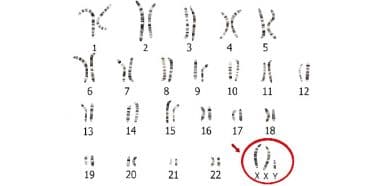 Klinefelter sendromu, X kromozomu