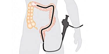 Kolonoskopinin riskleri