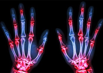 Romatoid artrit nedir? Nedenleri, belirtileri ve tedavi yöntemleri