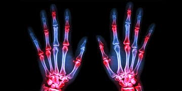 Romatoid artrit nedir? Nedenleri, belirtileri ve tedavi yöntemleri