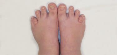 Turner Sendromu ayak