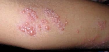 Zonanın belirtileri