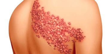 Zonanın belirtileri