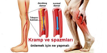 Kramp (kas spazmı) nedir? Neden olur? Belirtileri ve tedavisi