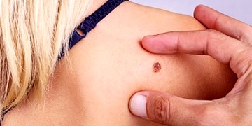 Melanom nedir? Cilt kanseri melanomun nedenleri, belirtileri ve tedavisi