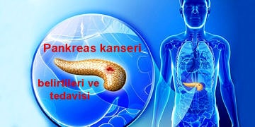 Pankreas kanseri neden olur? Belirtileri ve tedavisi