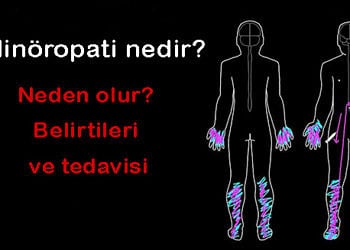 Polinöropati nedir? Neden olur? Belirtileri, türleri ve tedavisi