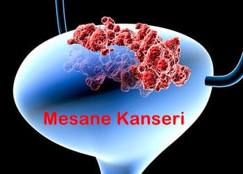 Mesane Kanseri nedir? Neden olur? Belirtileri ve tedavisi
