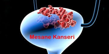 Mesane Kanseri nedir? Neden olur? Belirtileri ve tedavisi