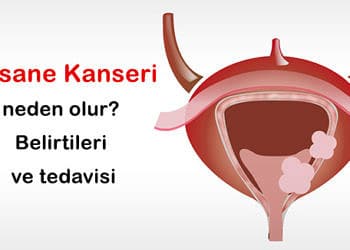 Mesane Kanseri nedir? Neden olur? Belirtileri ve tedavisi