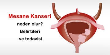 Mesane Kanseri nedir? Neden olur? Belirtileri ve tedavisi