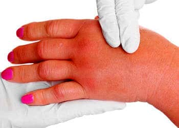 Arı sokması: Ne iyi gelir? Alerjisi, ilkyardım ve evde tedavi