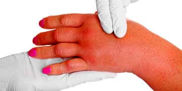 Arı sokması: Ne iyi gelir? Alerjisi, ilkyardım ve evde tedavi