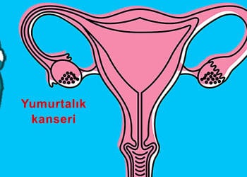Yumurtalık (over) kanseri neden olur? Belirtileri ve tedavisi