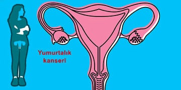 Yumurtalık (over) kanseri neden olur? Belirtileri ve tedavisi