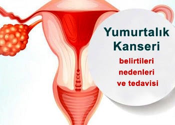 Yumurtalık (over) kanseri neden olur? Belirtileri ve tedavisi