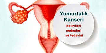 Yumurtalık (over) kanseri neden olur? Belirtileri ve tedavisi