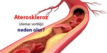 Ateroskleroz (damar sertliği) nedir? Neden olur? Belirtileri ve tedavisi