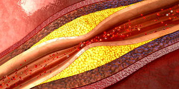 Prof. Dr. Canan Karatay: Damarları tıkayan kolesterol değildir!
