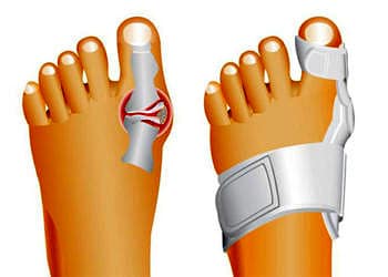 Halluks Valgus nedir? Neden olur? Belirtileri ve tedavisi