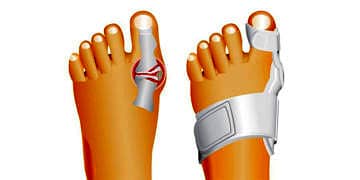 Halluks Valgus nedir? Neden olur? Belirtileri ve tedavisi