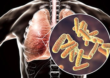 Enfeksiyonlara bağlı gelişen ölümlerde ‘Zatürre’ ilk sırada geliyor!