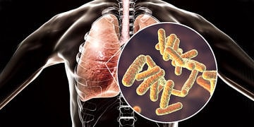 Enfeksiyonlara bağlı gelişen ölümlerde ‘Zatürre’ ilk sırada geliyor!