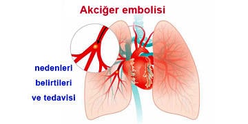 Akciğer (pulmoner) embolisi nedir, neden olur? Belirtileri ve tedavisi