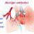 Akciğer (pulmoner) embolisi nedir, neden olur? Belirtileri ve tedavisi