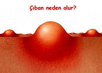 Çıban neden olur? Ne iyi gelir? Türleri ve tedavi yöntemleri