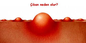 Çıban neden olur? Ne iyi gelir? Türleri ve tedavi yöntemleri