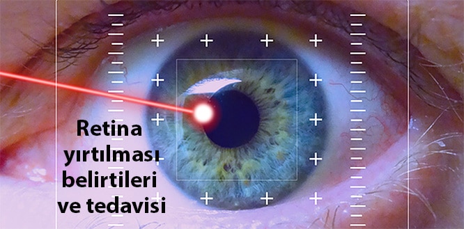 Retina Nedir Yirtilmasi Nasil Onlenir Hastaliklari Ve Tedavisi