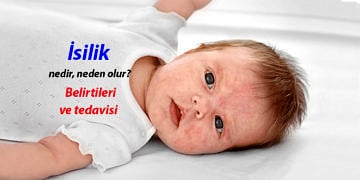 İsilik nedir, neden olur? İsiliğe ne iyi gelir? Belirtileri ve tedavisi