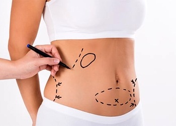 Liposuction nedir? Yağ aldırma ameliyatı nasıl yapılır, riskli midir?