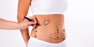 Liposuction nedir? Yağ aldırma ameliyatı nasıl yapılır, riskli midir?