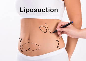 Liposuction nedir? Yağ aldırma ameliyatı nasıl yapılır, riskli midir?